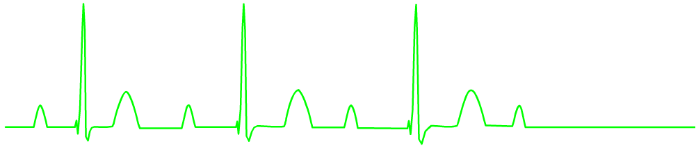 ekg